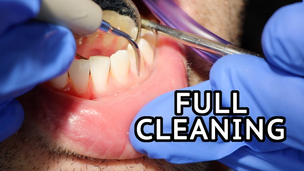 What Does a Dental Cleaning Entail